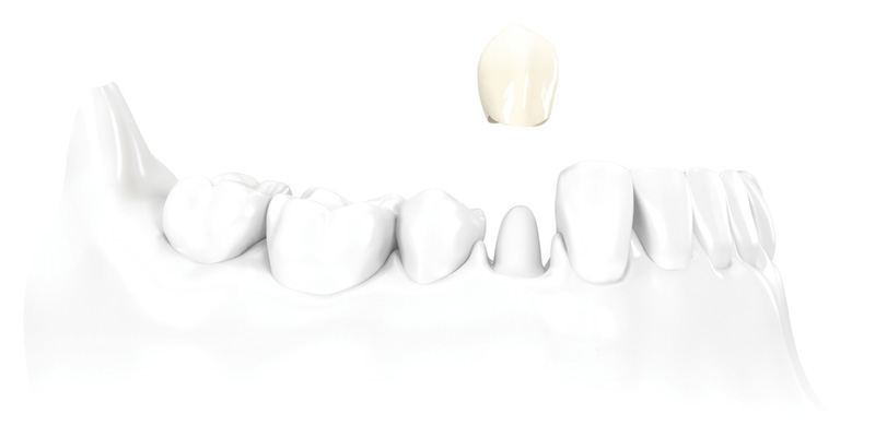 Aesthetic Crowns at PERFECT SMILE